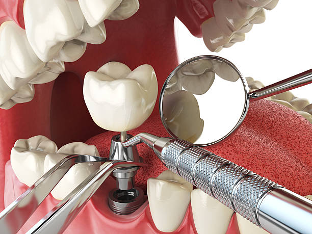 Best Emergency Denture Repair in Arlington, TX